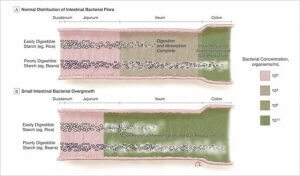 Image showing malabsorption of resistant starch with SIBO Image showing malabsorption of resistant starch with SIBO