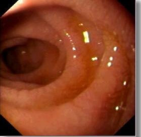 image villus atrophy