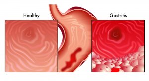 Low stomach acid and 6 common causes by Dr. Norm Robillard